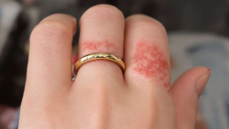 Risques d'allergie aux bijoux en or et comment les éviter