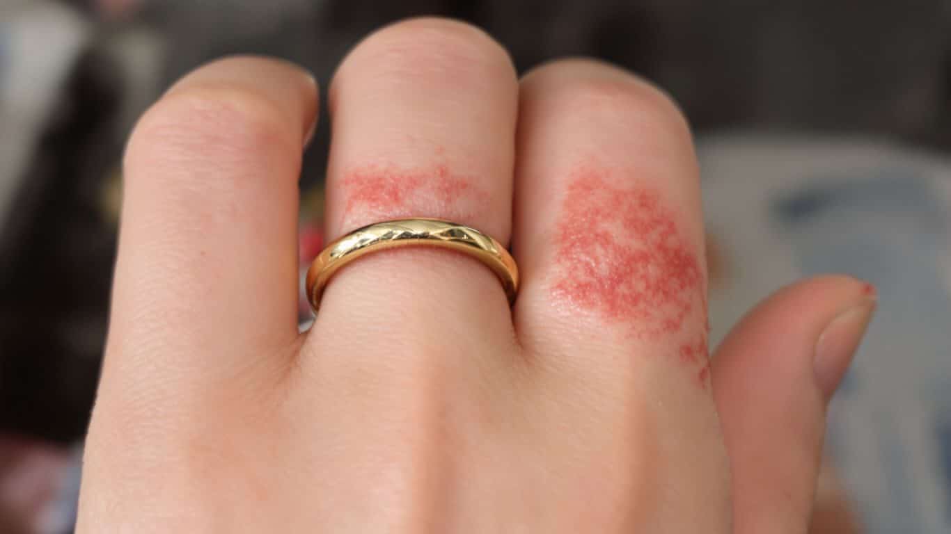 Risques d'allergie aux bijoux en or et comment les éviter
